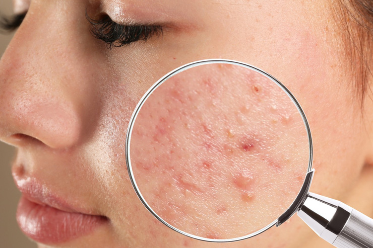 Treatment for pimples & scars