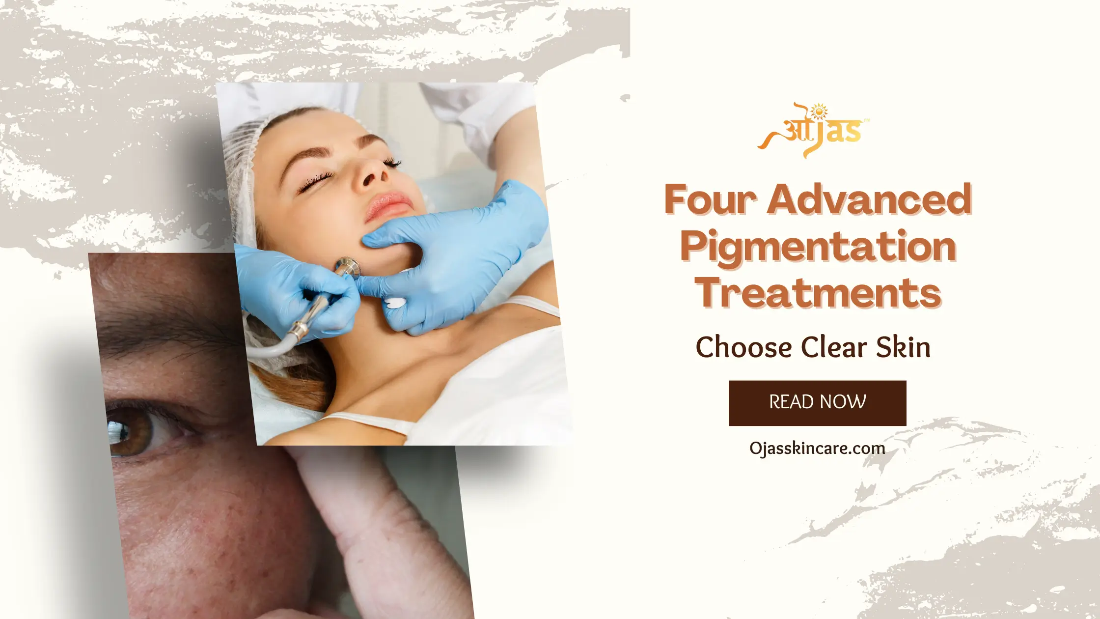 Four Advanced Pigmentation Treatments: Choose Clear Skin