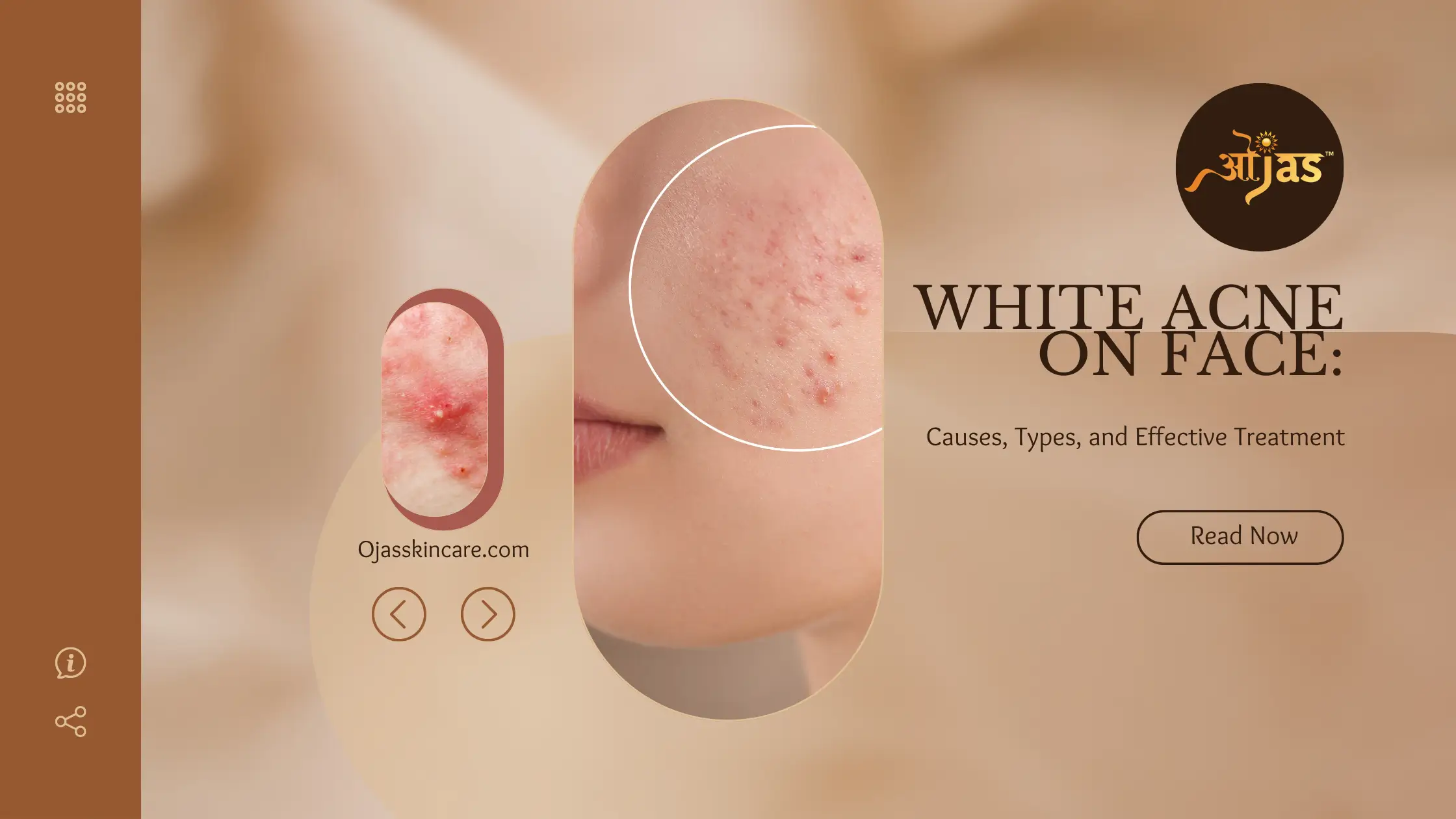 White Acne on Face: Causes, Types, and Effective Treatment